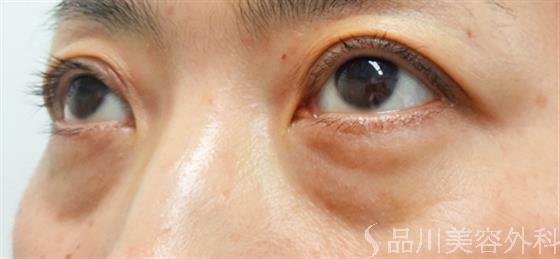 症例NO.24042のBEFORE写真