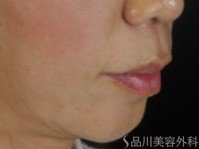 症例NO.72524のBEFORE写真