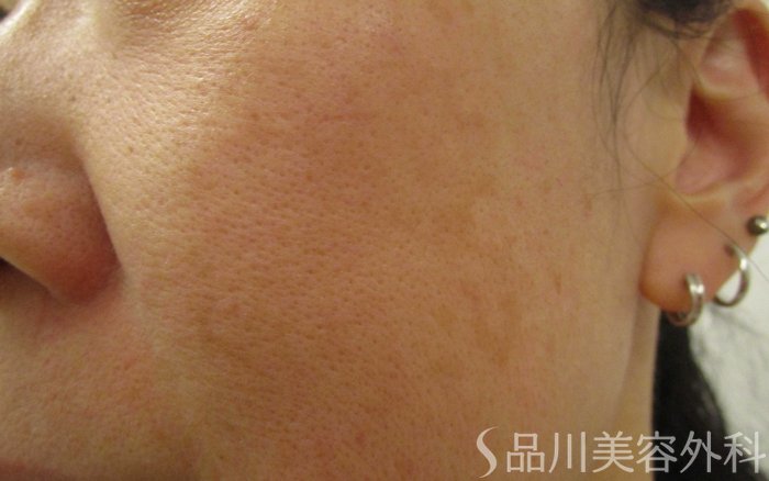 症例NO.70850のAFTER写真
