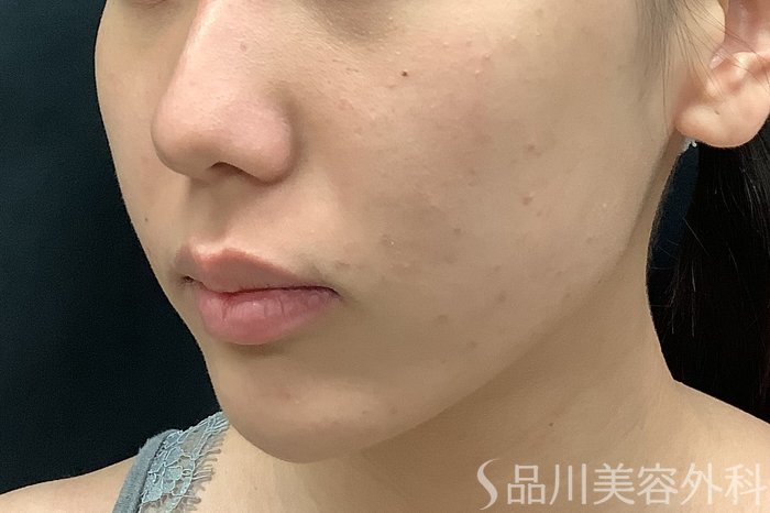 症例NO.67783のBEFORE写真