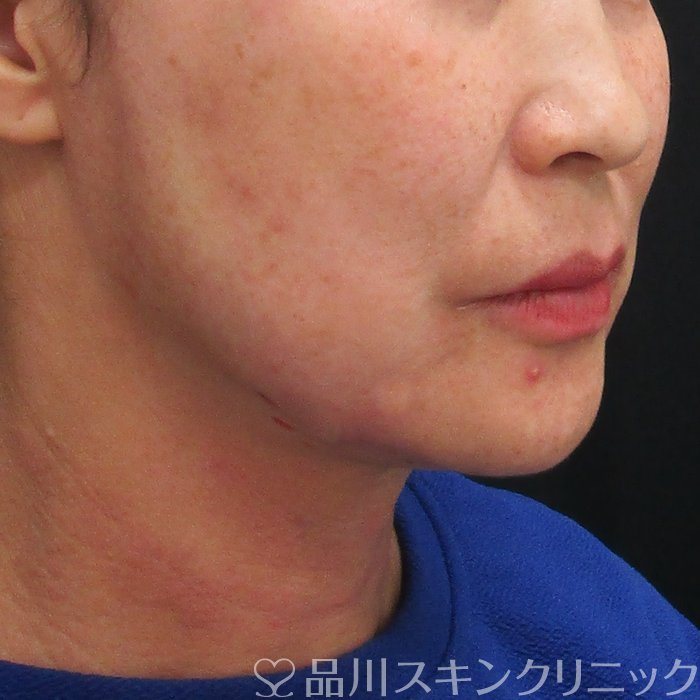 症例NO.74101のAFTER写真