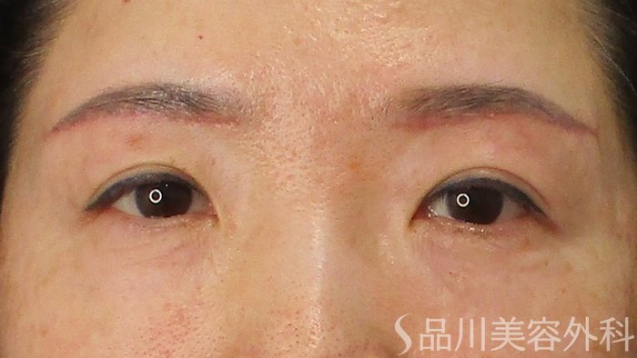 症例NO.73435のAFTER写真