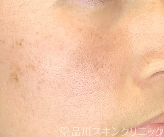 症例NO.65111のAFTER写真