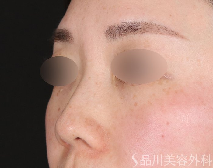 症例NO.72636のBEFORE写真