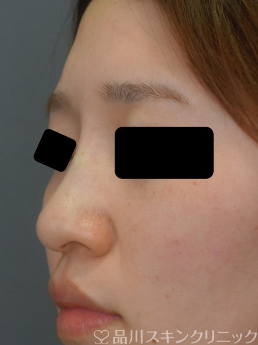 症例NO.73577のAFTER写真