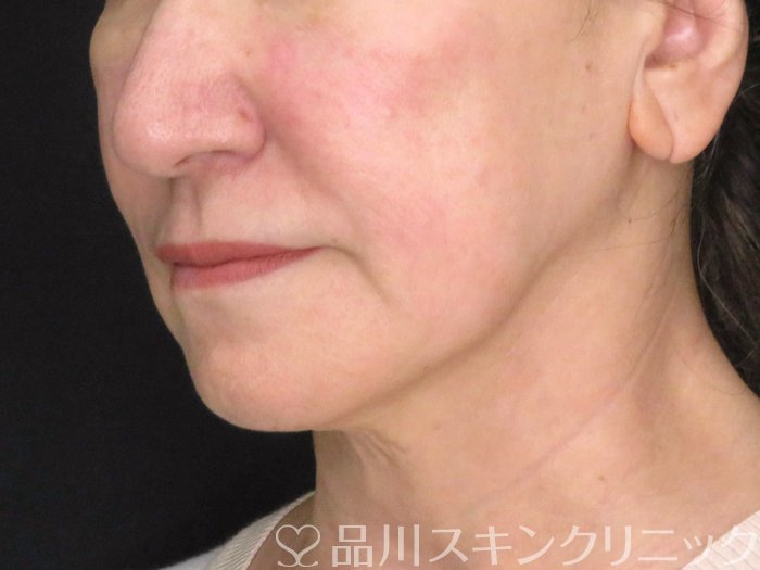 症例NO.67659のBEFORE写真