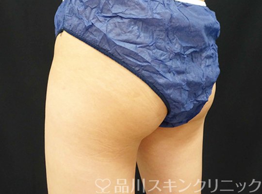 症例NO.70677のBEFORE写真