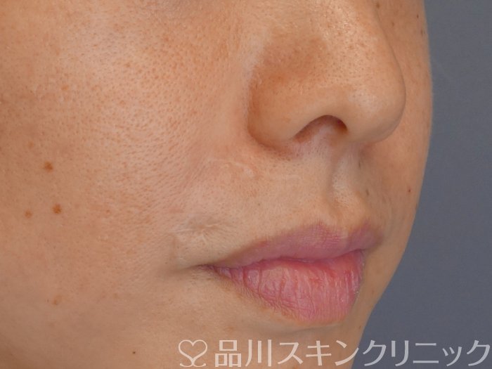症例NO.72120のAFTER写真