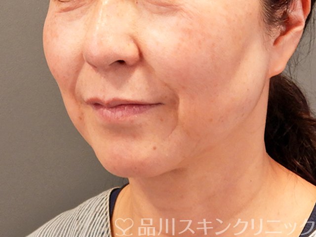 症例NO.70433のBEFORE写真