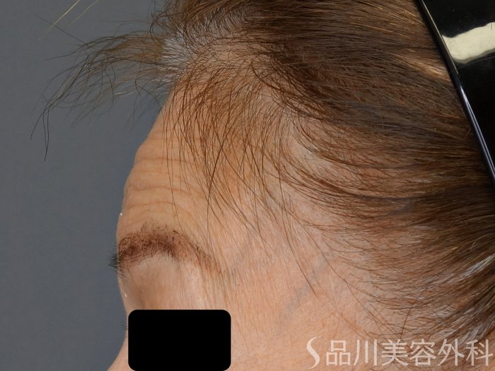 症例NO.74157のBEFORE写真
