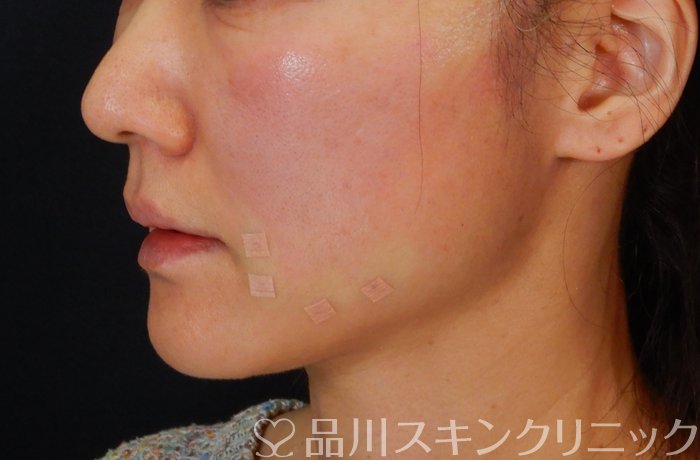 症例NO.66425のAFTER写真