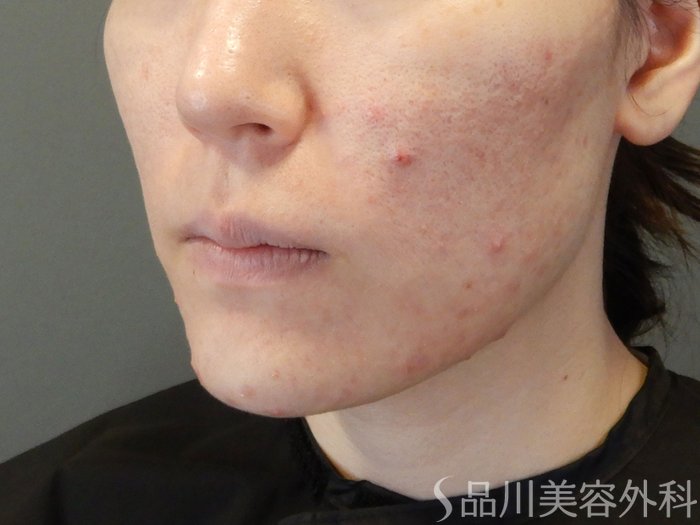 症例NO.65248のBEFORE写真