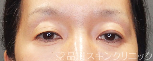 症例NO.75243のBEFORE写真