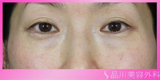 症例NO.54546のBEFORE写真