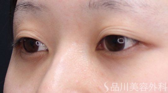 症例NO.71612のBEFORE写真