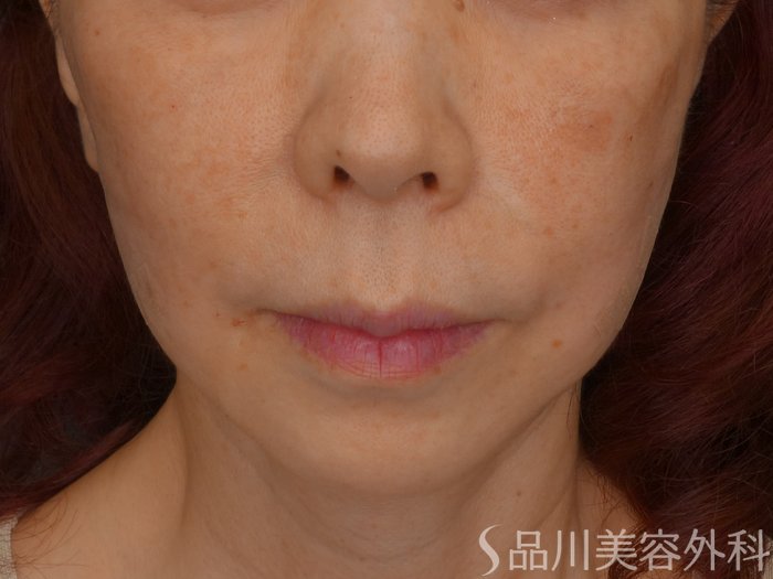 症例NO.73758のAFTER写真