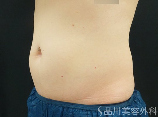 症例NO.70205のAFTER写真