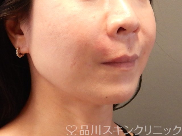 症例NO.63787のAFTER写真