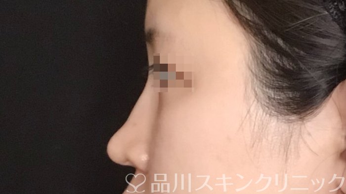 症例NO.65074のAFTER写真