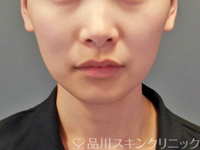 症例NO.64720のBEFORE写真