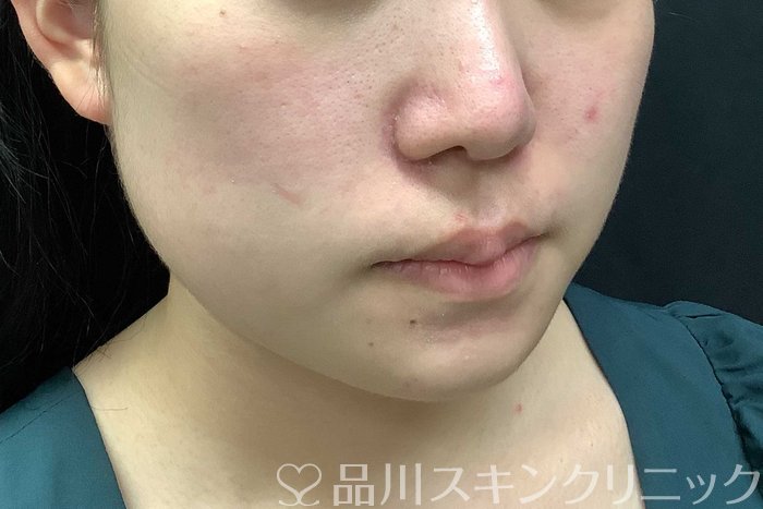 症例NO.69778のBEFORE写真
