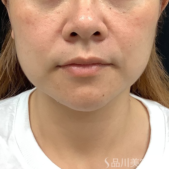 症例NO.75346のBEFORE写真
