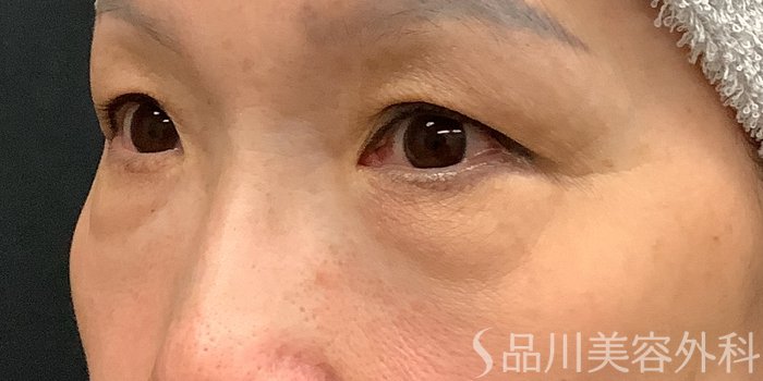 症例NO.71228のBEFORE写真