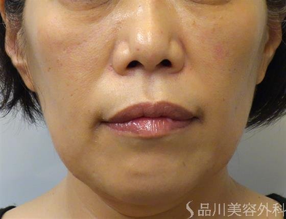 症例NO.40037のAFTER写真