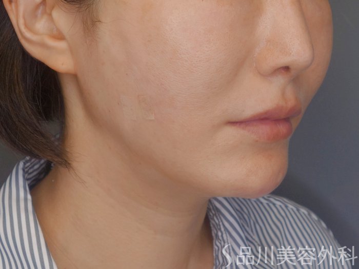 症例NO.71990のAFTER写真