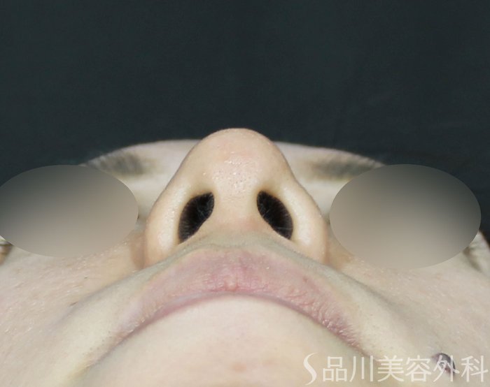 症例NO.71839のAFTER写真