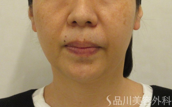 症例NO.73810のBEFORE写真