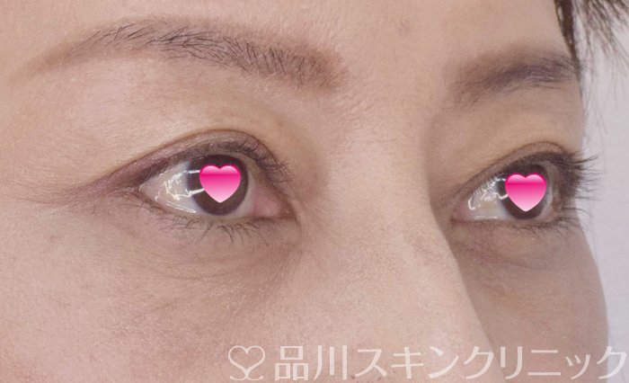 症例NO.63053のAFTER写真