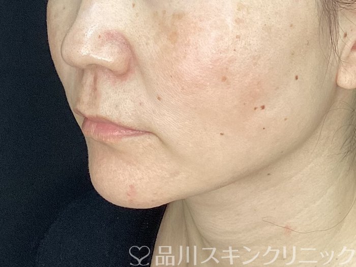 症例NO.72496のAFTER写真