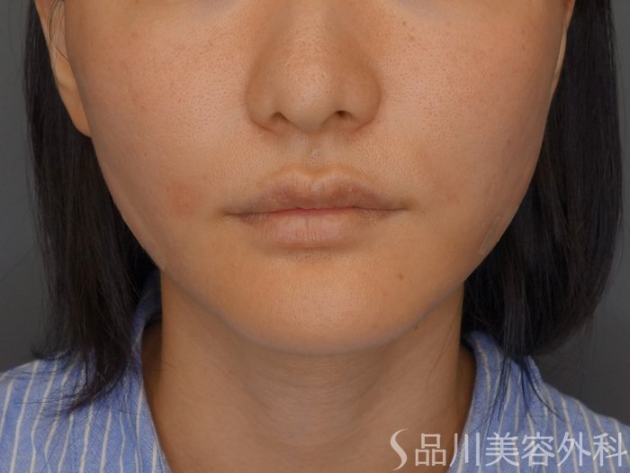 症例NO.71849のAFTER写真