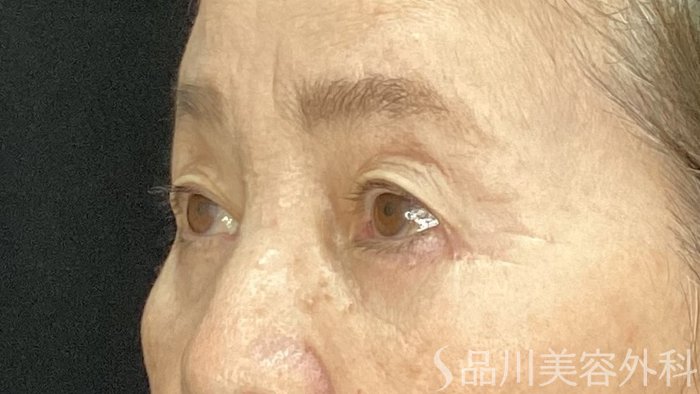 症例NO.72224のAFTER写真