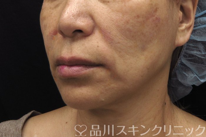 症例NO.74606のBEFORE写真