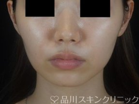 症例NO.74305のBEFORE写真