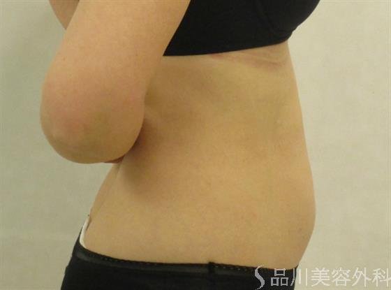 症例NO.43231のAFTER写真