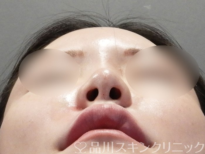 症例NO.72813のAFTER写真