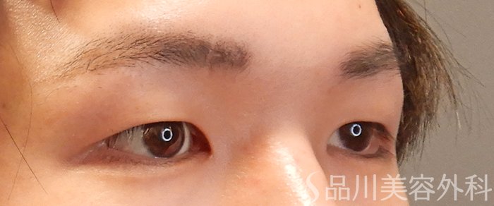 症例NO.69804のBEFORE写真