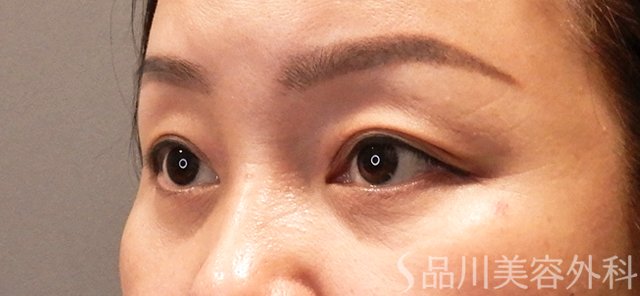 症例NO.70675のBEFORE写真
