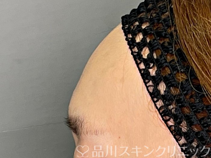 症例NO.70130のBEFORE写真