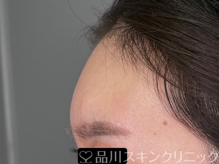 症例NO.69717のAFTER写真
