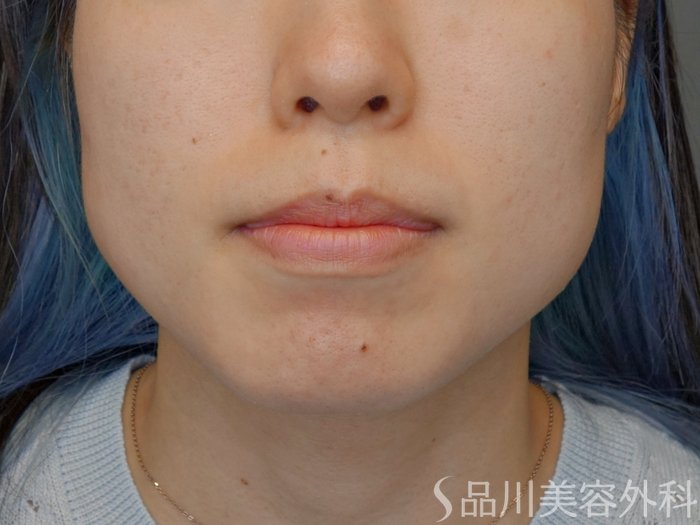 症例NO.71861のBEFORE写真