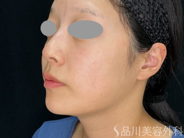 症例NO.72247のBEFORE写真