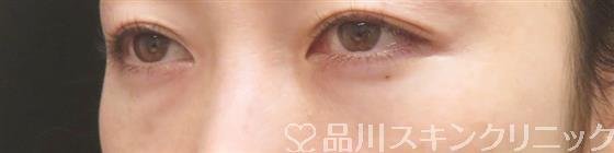 症例NO.59364のAFTER写真