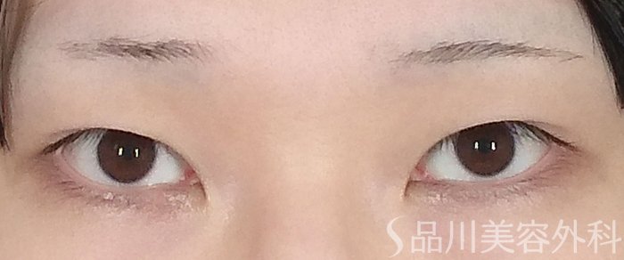症例NO.65550のBEFORE写真