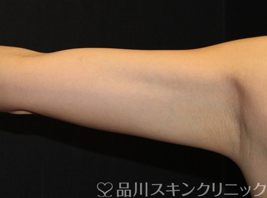 症例NO.71926のAFTER写真