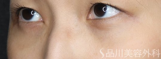 症例NO.73503のAFTER写真