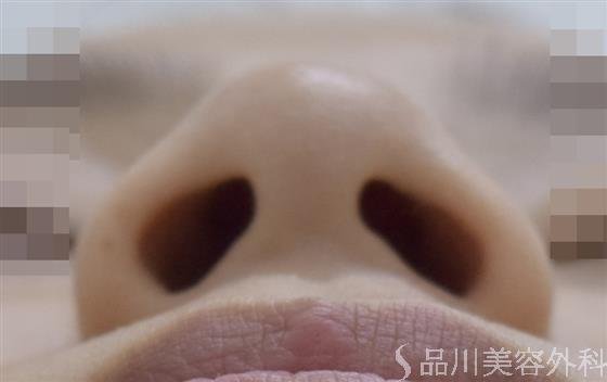 症例NO.47156のBEFORE写真